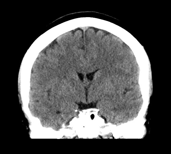 File:Cerebral venous infarct related to dural venous sinus thromboses (Radiopaedia 35292-36804 Coronal non-contrast 17).png