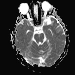 File:Cerebral venous infarction - hemorrhagic (Radiopaedia 81625-95505 Axial ADC 8).jpg