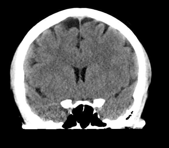 File:Cerebral venous infarction due to transverse sinus thrombosis (Radiopaedia 34688-36116 Coronal non-contrast 16).png