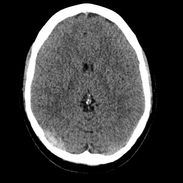 Cerebral venous sinus thrombosis (Radiopaedia 59224-66551 Axial non-contrast 13).jpg