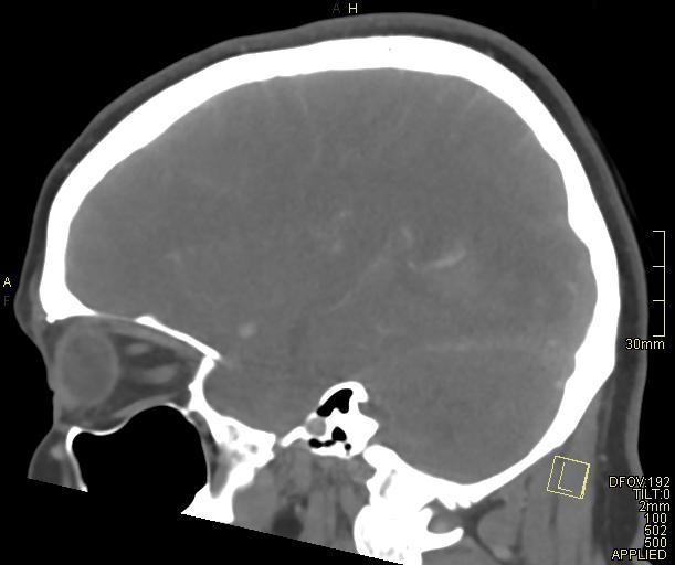 Cerebral venous sinus thrombosis (Radiopaedia 91329-108965 Sagittal venogram 51).jpg