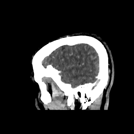 File:Cerebral venous thrombosis (CVT) (Radiopaedia 77524-89685 Sagittal CTV 1).jpg