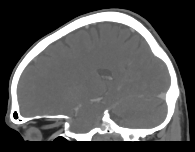 Cerebral venous thrombosis (Radiopaedia 38392-40467 D 34).png