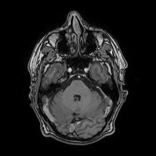 File:Cerebral venous thrombosis with secondary intracranial hypertension (Radiopaedia 89842-106957 Axial T1 C+ 61).jpg