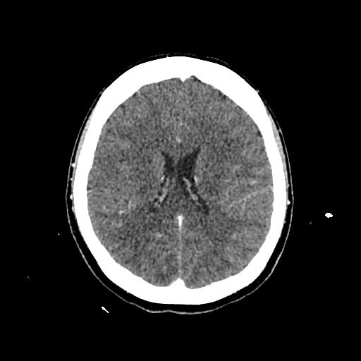 Cerebral venous thrombosis with venous hemorrhagic infarct (Radiopaedia 90354-107660 Axial with contrast 103).jpg