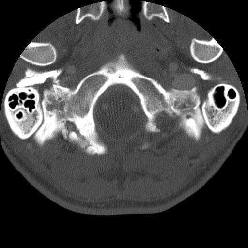 Cervical Pott disease (Radiopaedia 20374-20286 Axial bone window 11).jpg