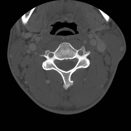 Cervical Pott disease (Radiopaedia 20374-20286 Axial bone window 69).jpg