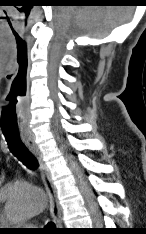 Cervical canal stenosis - OPLL and osteophytes (Radiopaedia 47329-51910 B 39).png