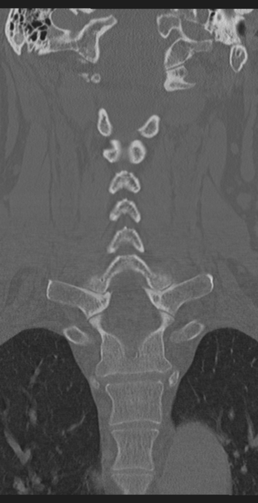 Cervical canal stenosis due to ossification of the posterior longitudinal ligament (Radiopaedia 47260-51823 Coronal bone window 34).png