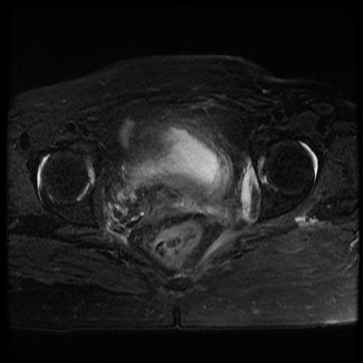 File:Cervical carcinoma (Radiopaedia 70924-81132 Axial T2 fat sat 10).jpg