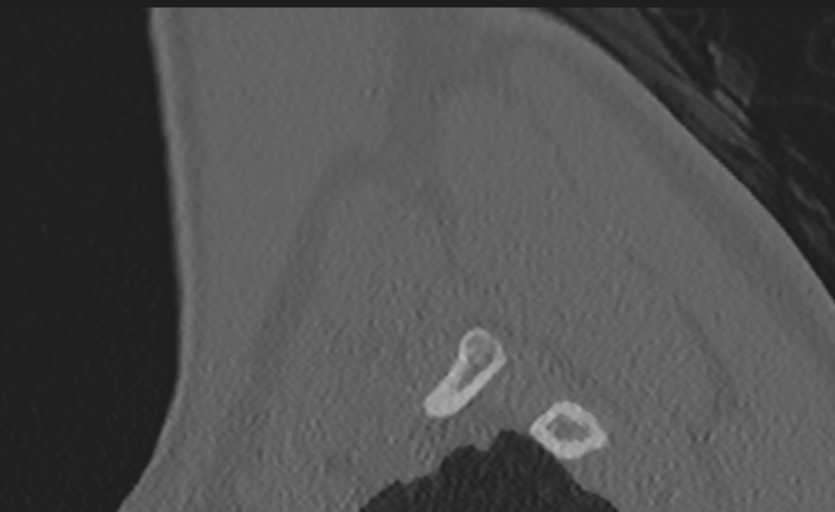 Cervical disc replacement (Radiopaedia 37383-39205 Sagittal bone window 7).png