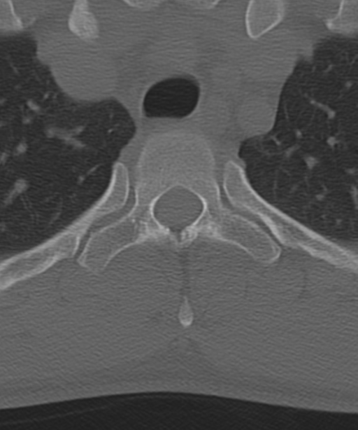 Cervical intercalary bone (Radiopaedia 35211-36748 Axial bone window 71).png