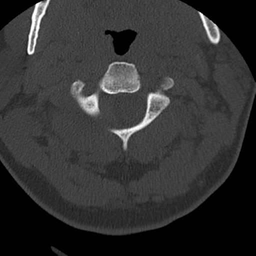File:Cervical schwannoma (Radiopaedia 57979-64974 Axial bone window 16).png