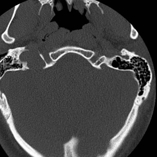 Cervical schwannoma (Radiopaedia 57979-64974 Axial bone window 6).png