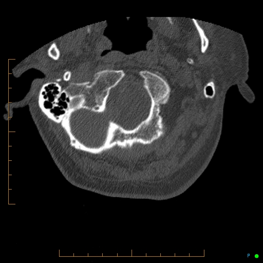File:Cervical spine fracture - ankylosing spondylitis (Radiopaedia 76835-88706 Axial bone window 8).jpg
