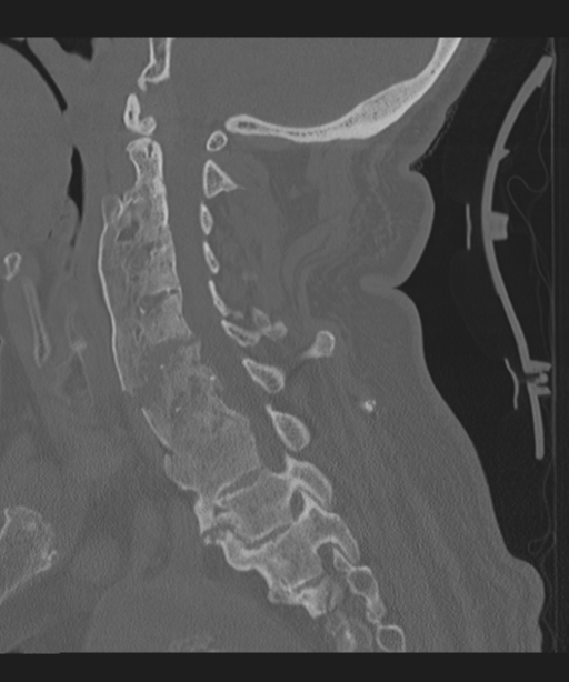 Cervical spine fracture in the setting of ankylosis (Radiopaedia 37038-38715 Sagittal bone window 35).png