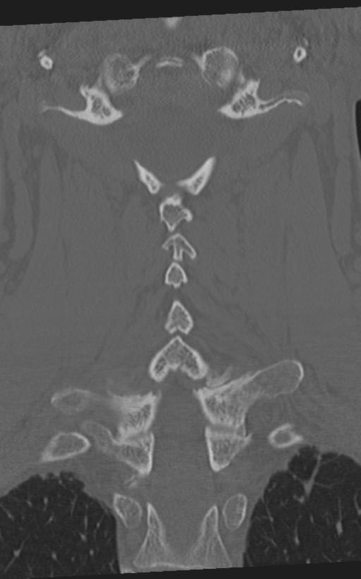 Cervical spine fractures with vertebral artery dissection (Radiopaedia 53296-59268 Coronal bone window 43).png
