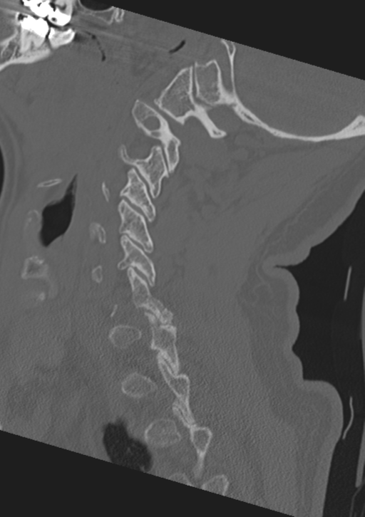 Cervical spine fractures with vertebral artery dissection (Radiopaedia 53296-59268 Sagittal bone window 21).png