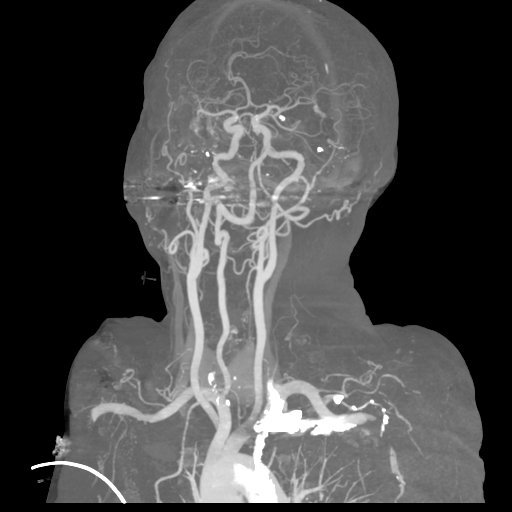 File:Cervical spine fractures with vertebral artery dissection (Radiopaedia 53296-59269 3D MIP 13).png
