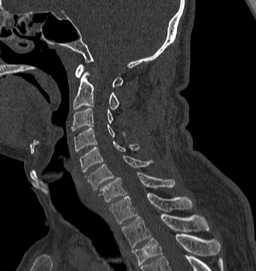 Cervical spine trauma with tear drop fracture and perched facet joint (Radiopaedia 53989-60127 Sagittal bone window 73).jpg