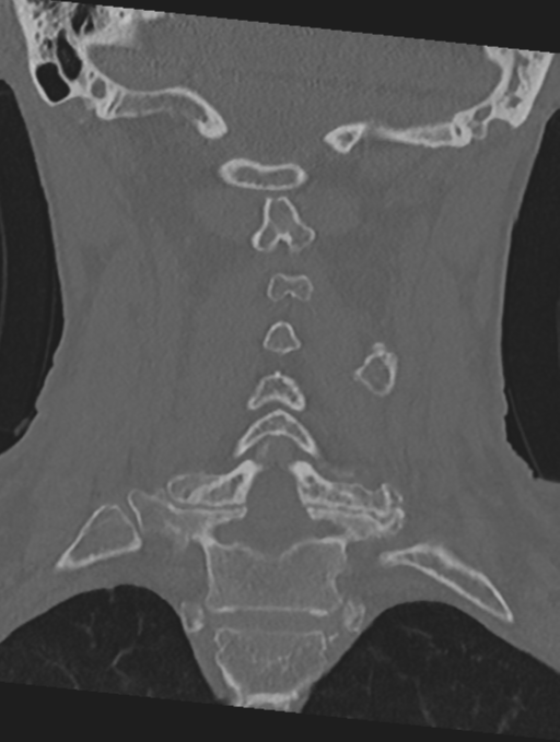 Cervical spondylolysis (Radiopaedia 49616-54811 Coronal bone window 32).png