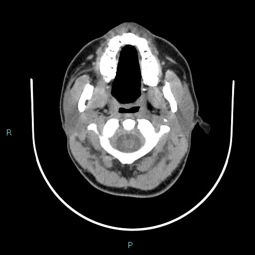 Cervical thymic cyst (Radiopaedia 88632-105335 Axial non-contrast 93).jpg