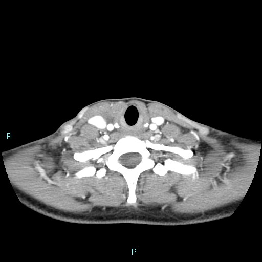 Cervical thymic cyst (Radiopaedia 88632-105335 B 39).jpg
