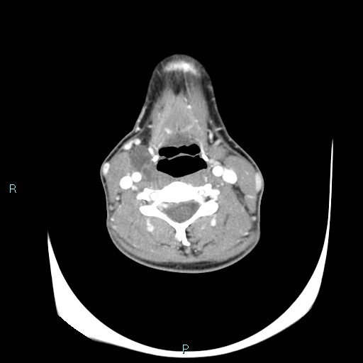Cervical thymic cyst (Radiopaedia 88632-105335 B 61).jpg