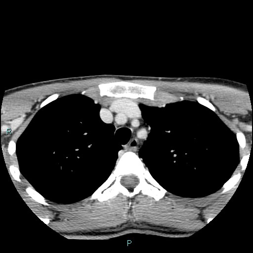 Cervical thymic cyst (Radiopaedia 88632-105335 C 7).jpg