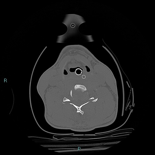 File:Cervical vertebral burst fracture (Radiopaedia 37420-39258 Axial bone window 19).jpg