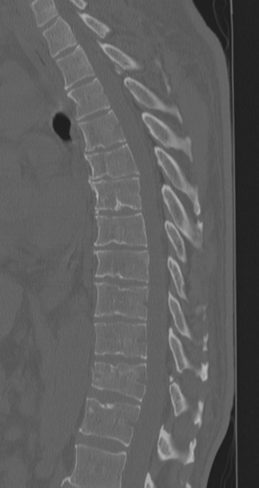 Chance fracture (Radiopaedia 33854-35020 Sagittal bone window 44).png