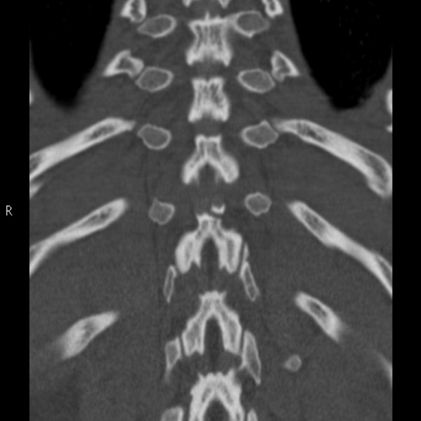Chance fracture (Radiopaedia 36521-38081 Coronal bone window 50).jpg