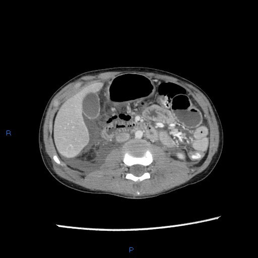 File:Chance fracture with duodenal and pancreatic lacerations (Radiopaedia 43477-46864 A 17).jpg