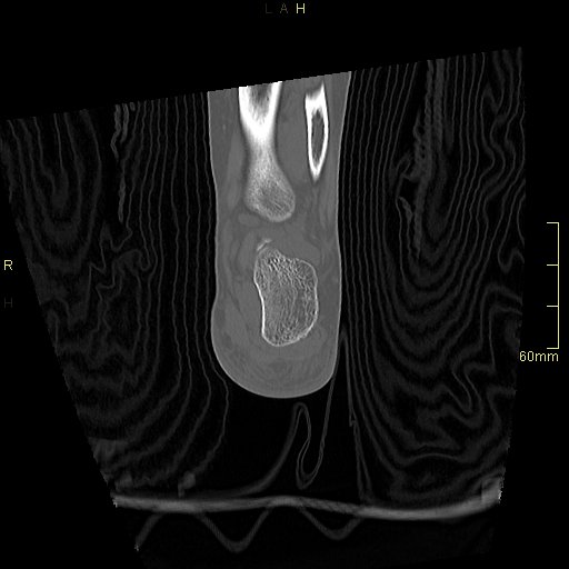 Chaput tubercle fracture (Radiopaedia 80319-93956 Coronal non-contrast 50).jpg