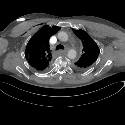File:Chest multitrauma - aortic injury (Radiopaedia 34708-36147 A 106).png