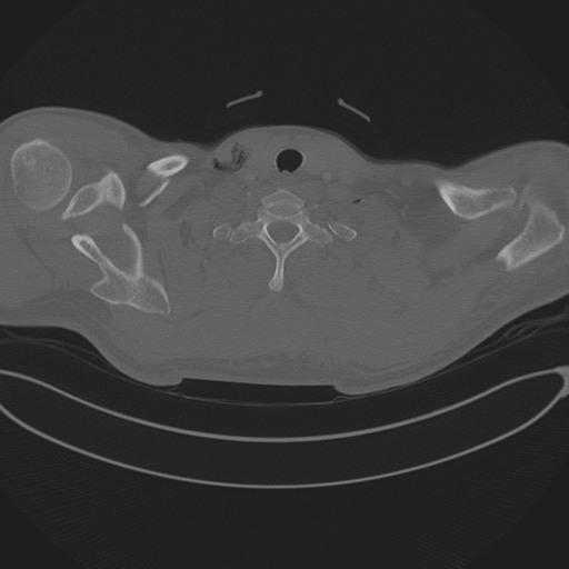 Chest multitrauma - aortic injury (Radiopaedia 34708-36147 Axial bone window 4).png