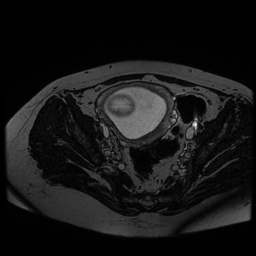 Chiari II malformation - fetal MRI (Radiopaedia 68099-77581 Axial Fiesta 48).jpg