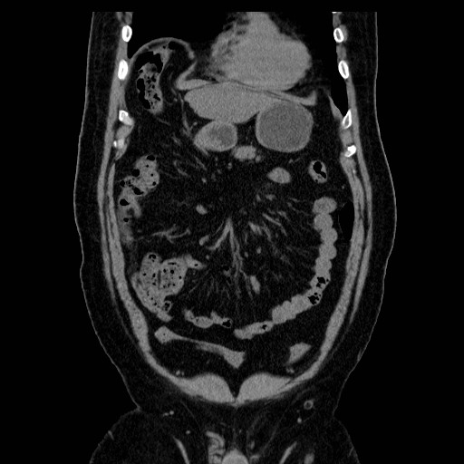 File:Chilaiditi’s syndrome (Radiopaedia 27550-27756 Coronal non-contrast 15).jpg