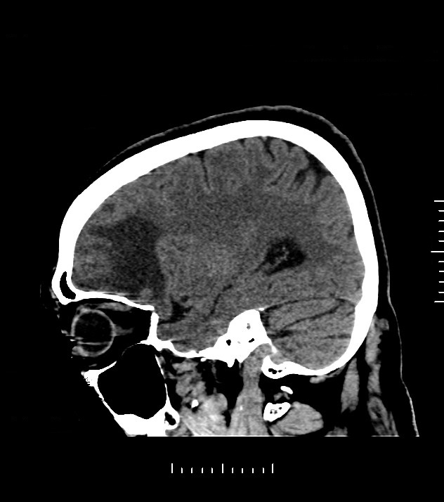 Cholangiocarcinoma with cerebral metastases (Radiopaedia 83519-98628 C 39).jpg