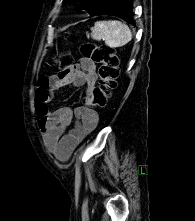 Cholangiocarcinoma with cerebral metastases (Radiopaedia 83519-98629 F 24).jpg