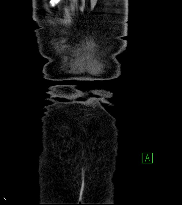Cholangiocarcinoma with cerebral metastases (Radiopaedia 83519-98629 G 83).jpg