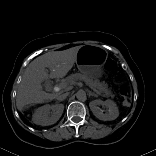 File:Cholecystitis - obstructive choledocholitiasis (CT intravenous cholangiography) (Radiopaedia 43966-47479 Axial 82).png