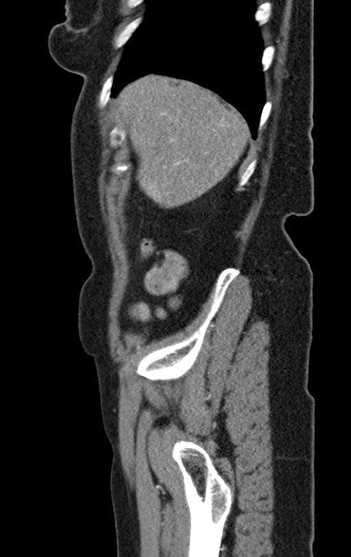 Cholecystoduodenal fistula due to calculous cholecystitis with gallstone migration (Radiopaedia 86875-103077 C 54).jpg