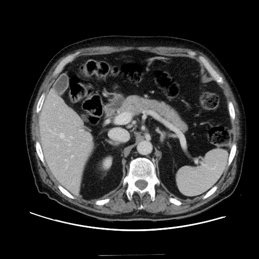 Choledocholiathiasis with normal caliber common bile duct (Radiopaedia 75368-86632 A 62).jpg