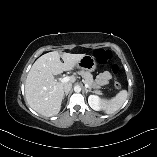 File:Choledocholithiasis after recent cholecystectomy (Radiopaedia 60929-68737 Axial 37).jpg