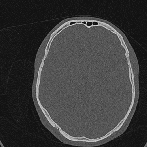 Cholesteatoma (Radiopaedia 70429-80529 Axial bone window 152).jpg
