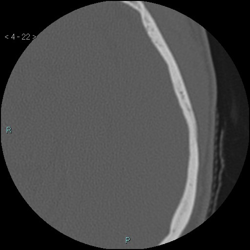 File:Cholesterol granuloma of the petrous apex (Radiopaedia 64358-73141 Axial bone window 11).jpg