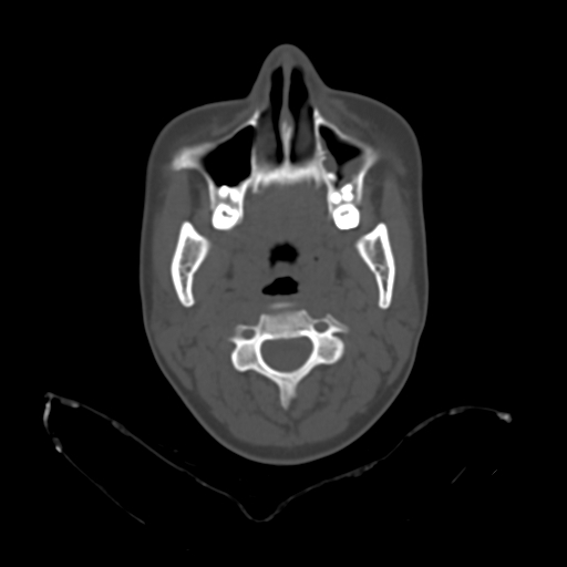 File:Chondroblastic osteosarcoma (Radiopaedia 67363-76741 Axial bone window 7).jpg