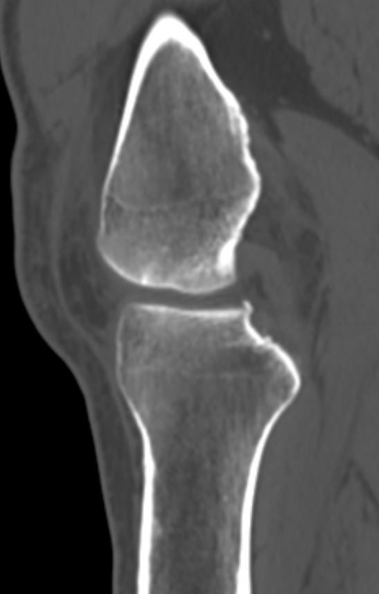 Chondrocalcinosis (Radiopaedia 82862-97173 Sagittal bone window 26).jpg