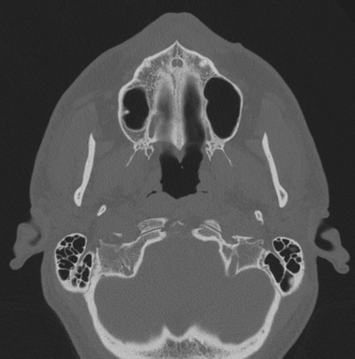 Chondrosarcoma (clivus) (Radiopaedia 46895-51425 Axial bone window 73).png